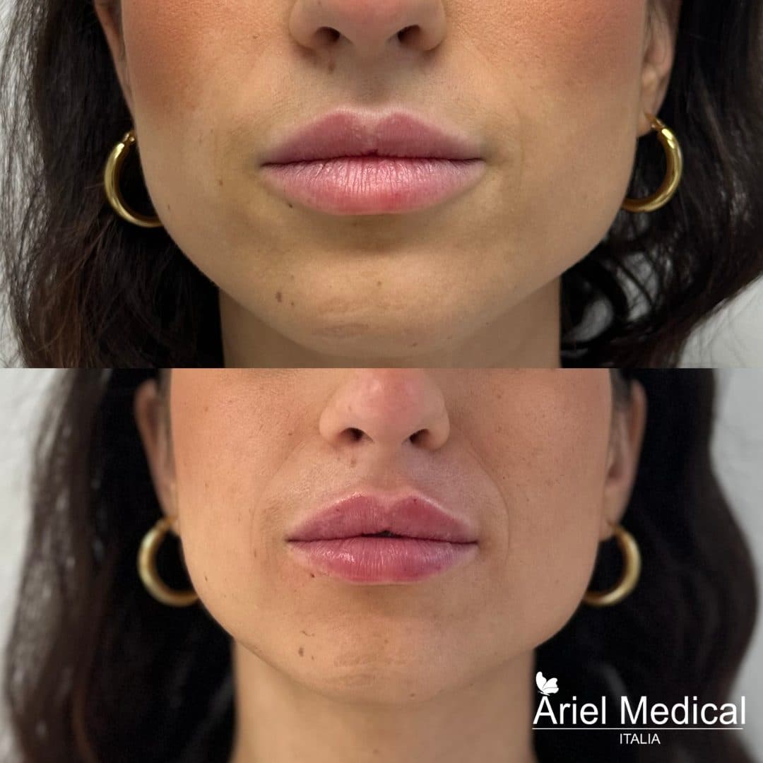 Filler labbra — Prima e dopo