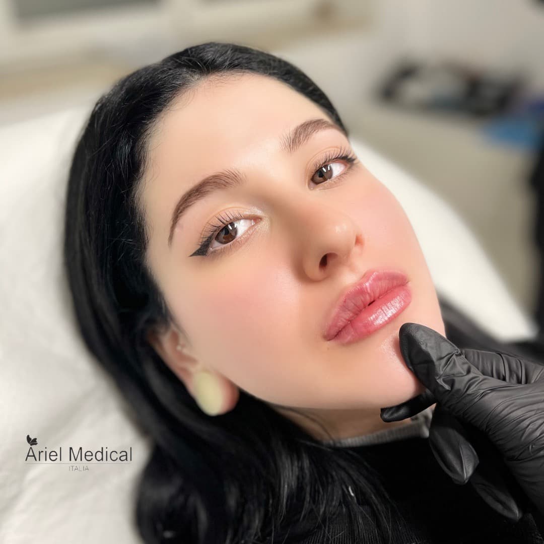 Filler labbra — Risultato naturale