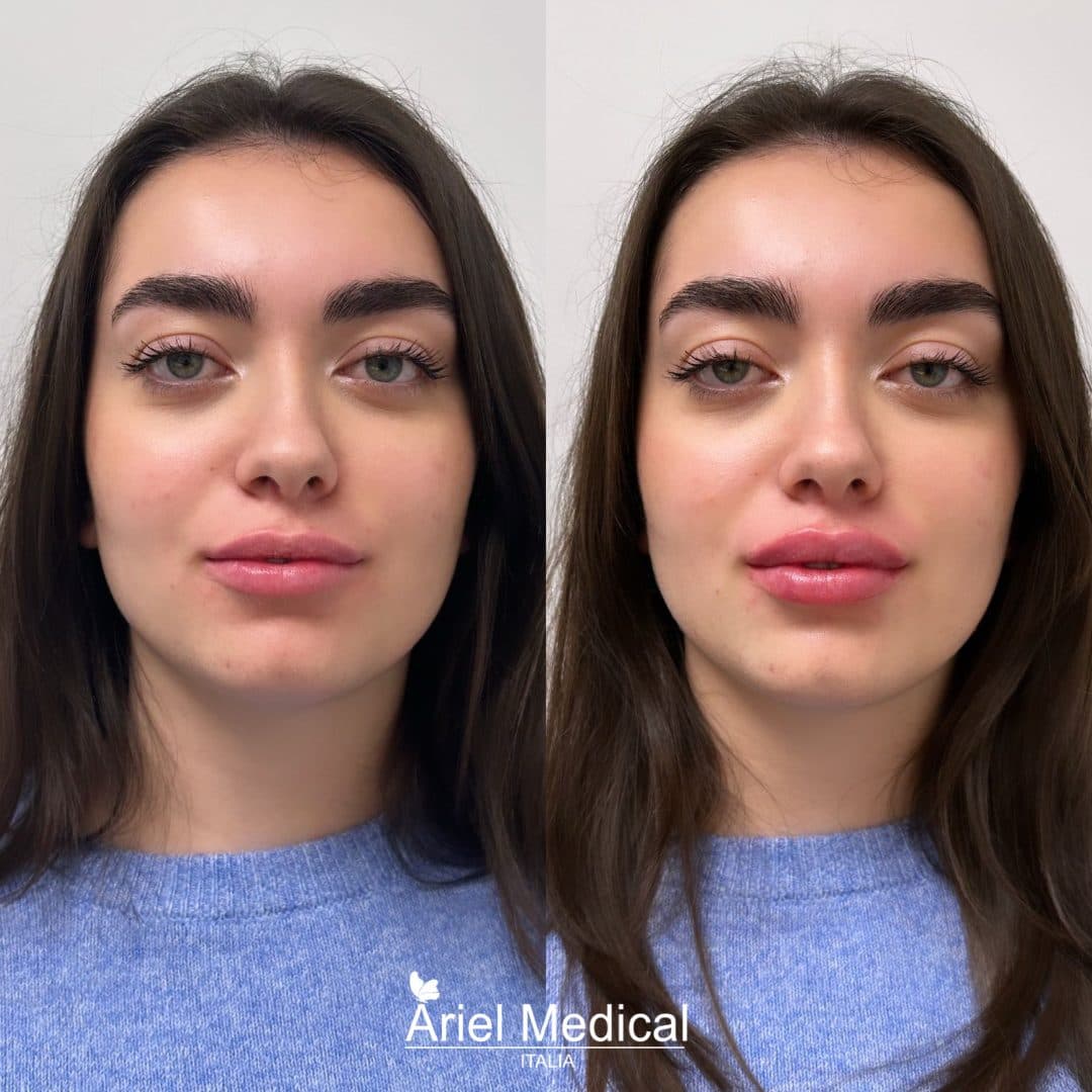 Filler labbra — Volume naturale